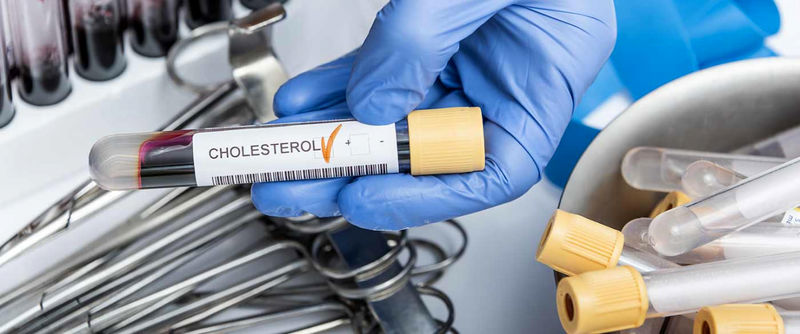 total cholesterol در آزمایش خون چیست؟