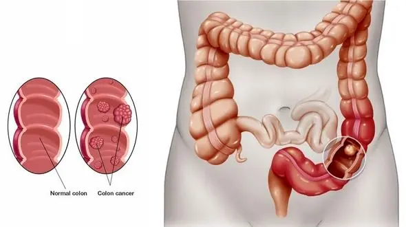 4 ماده غذایی مفید برای پیشگیری از سرطان روده بزرگ 