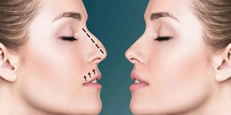 بهترین جراح بینی در ایلام کیه؟ - تصویر 2
