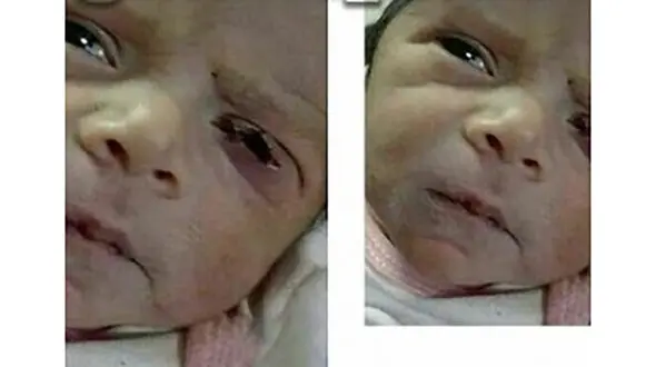 پرونده قصور پزشکی در حادثه پارگی پلک نوزاد نطنزی به کجا رسید؟+ عکس