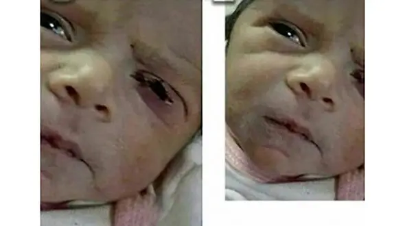 پرونده قصور پزشکی در حادثه پارگی پلک نوزاد نطنزی به کجا رسید؟+ عکس