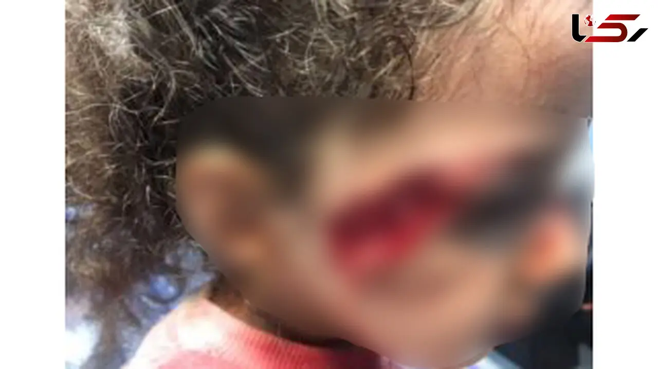 حمله وحشتناک سگ ولگرد به دختر ۵ ساله تبریزی