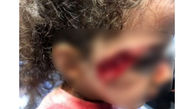 حمله وحشتناک سگ ولگرد به دختر ۵ ساله تبریزی