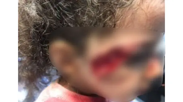 جزییات حمله وحشتناک سگ های ولگرد به دختر 5 ساله تبریزی + عکس