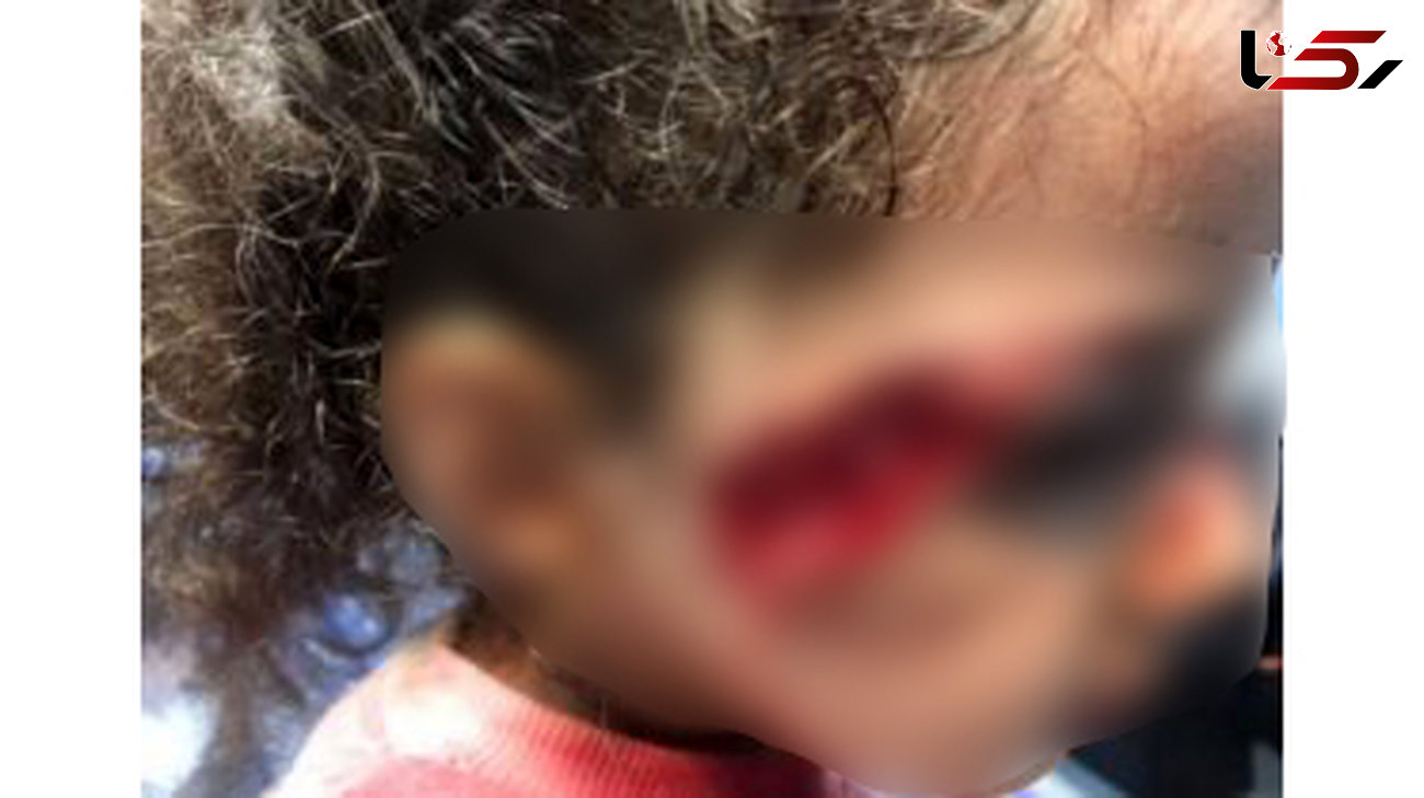 جزییات حمله وحشتناک سگ های ولگرد به دختر 5 ساله تبریزی + عکس