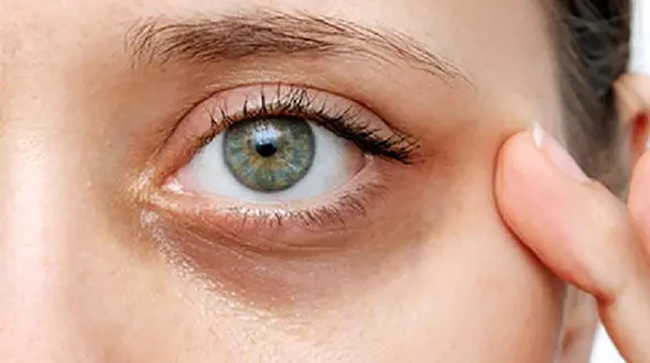 علل تیرگی زیر چشم + راه درمان