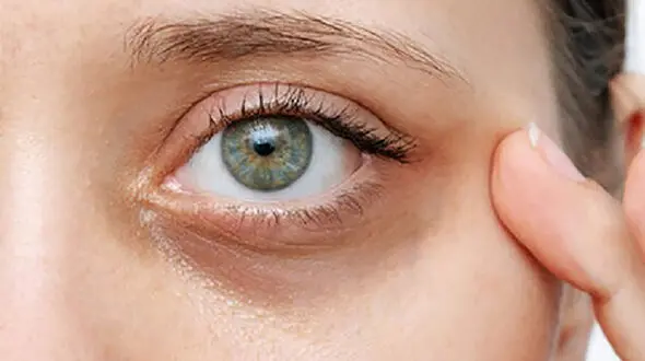 علل تیرگی زیر چشم + راه درمان