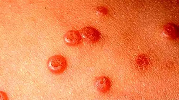 فاجعه آماری در طلاق زوجین به علت زگیل تناسلی + صوت