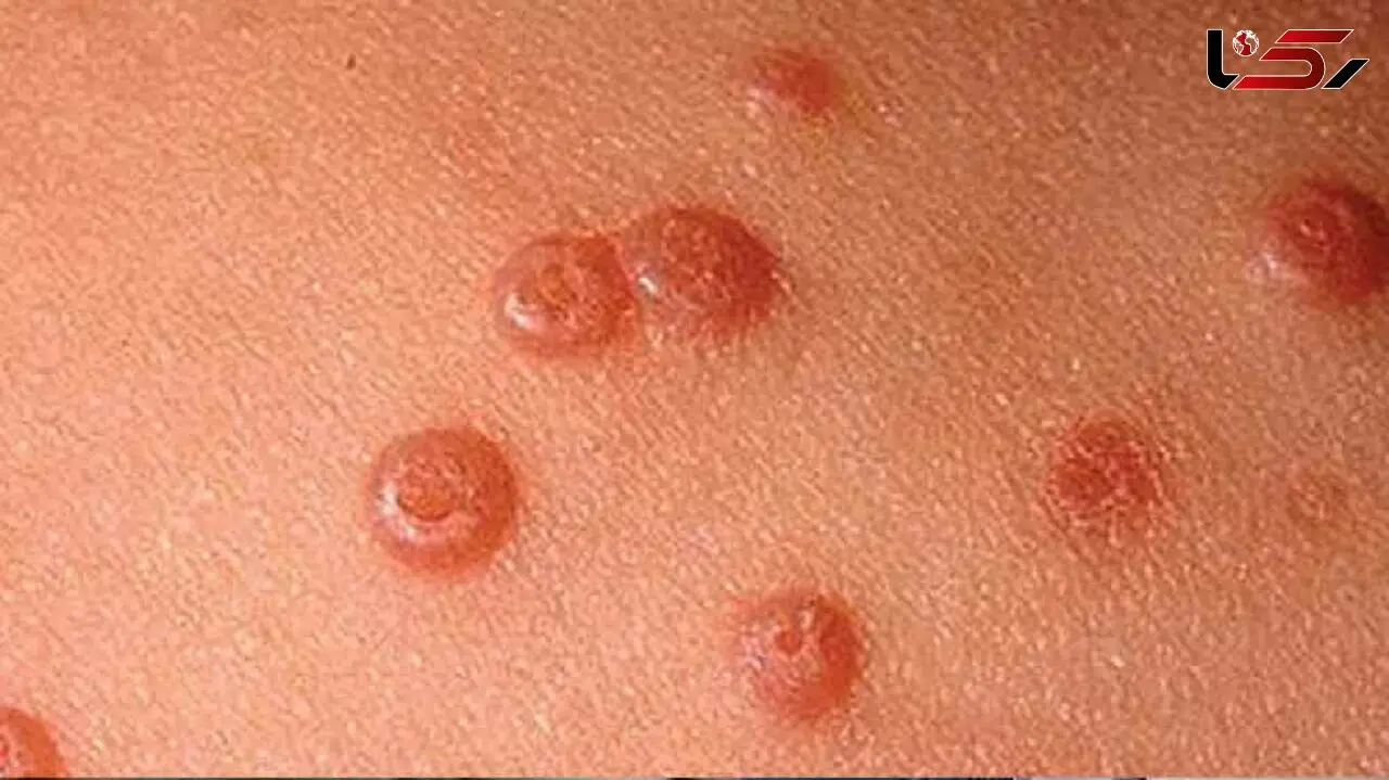 فاجعه آماری در طلاق زوجین به علت زگیل تناسلی + صوت
