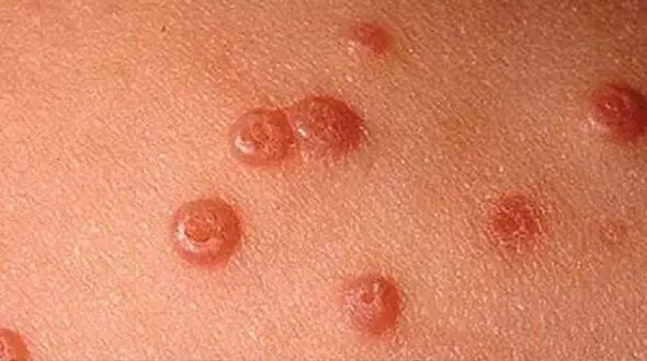فاجعه آماری در طلاق زوجین به علت زگیل تناسلی + صوت