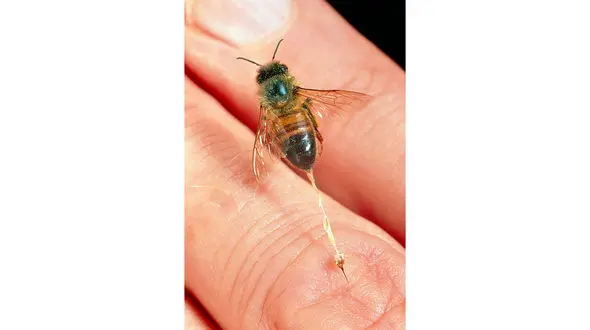 درمان نیش زنبور