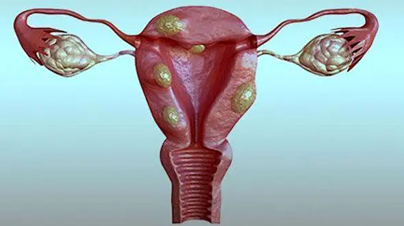 فیبروم رحم چیست؟  / علائم ترکیدن فیبروم رحم چیست؟