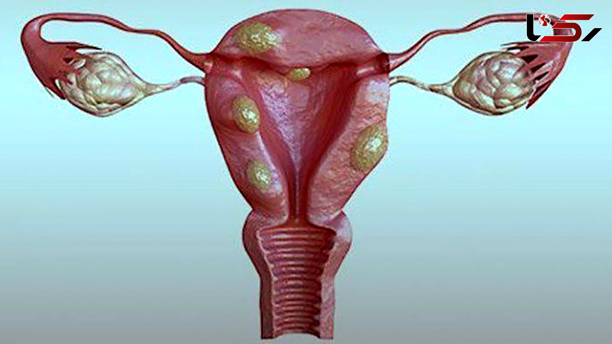  فیبروم رحم چیست؟ / علائم ترکیدن فیبروم رحم چیست؟ 