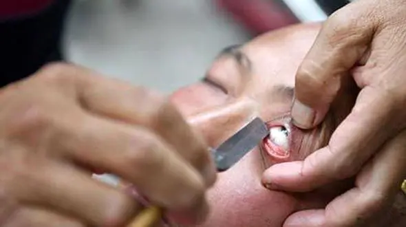 کارهای چندش آور آرایشگران چینی/تراشیدن داخل چشم+تصاویر