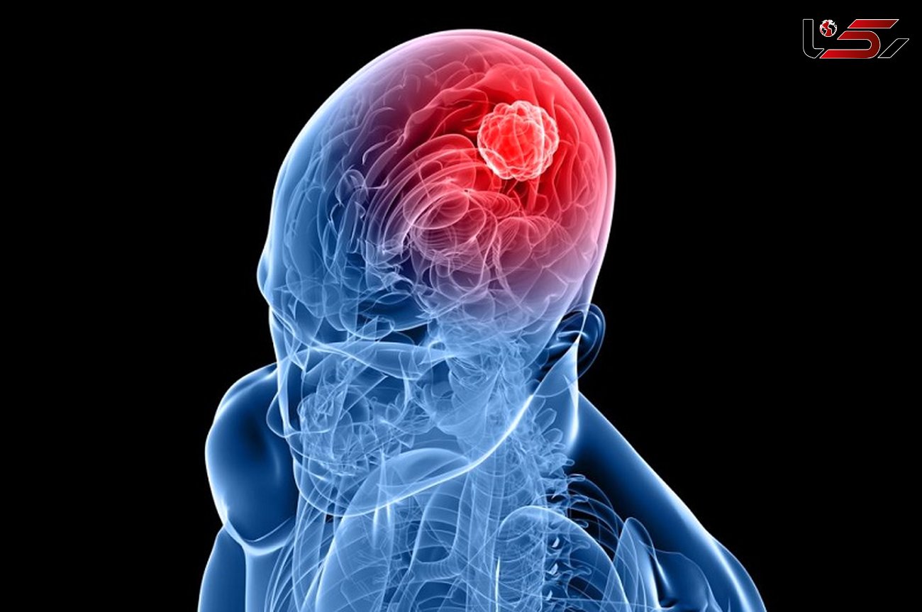 علائم و درمان تومورهای مغزی