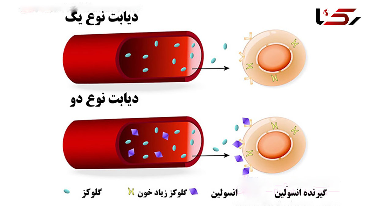 دیابت نوع یک و 2 چه فرقی دارند؟ / فیلم