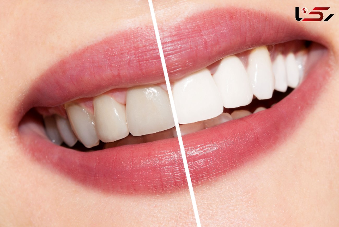 پودرهای سفید کننده عامل خرابی دندان ها
