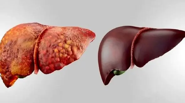 بهترین ویتامین‌ ها برای محافظت از کبد: 5 گزینه برتر