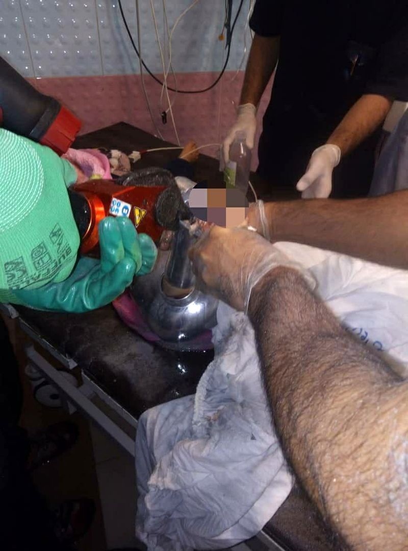 گیر کردن دست کودک ۴ ساله در چرخ گوشت 