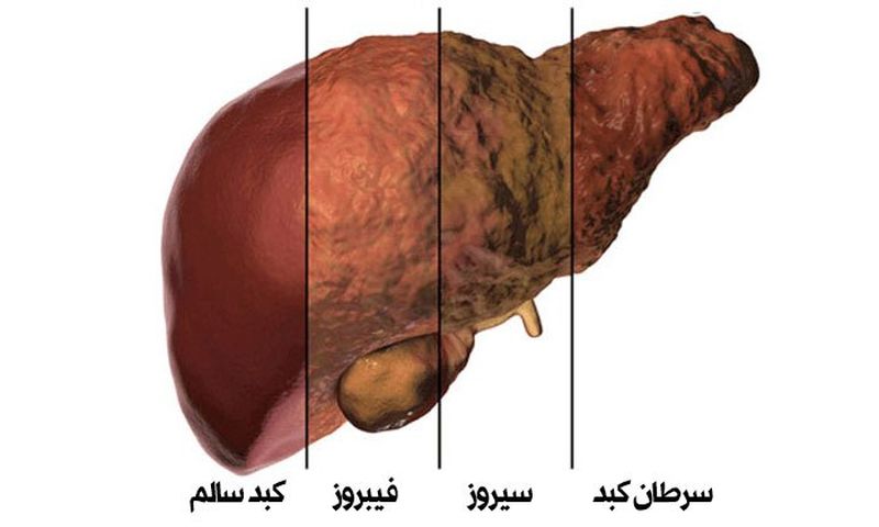 کبد سالم و چرب