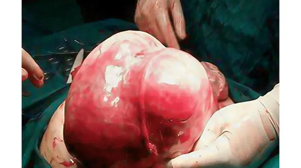 توده 7  کیلویی از رحم یک بیمار در اردبیل خارج شد