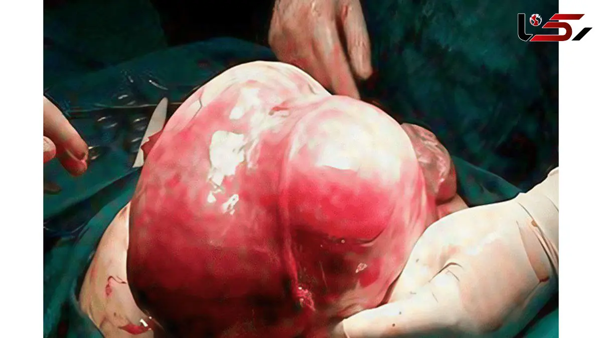توده 7  کیلویی از رحم یک بیمار در اردبیل خارج شد