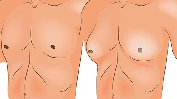 ژنیکوماستی چیست؟ / جدول مواد غذایی مفید و مضر برای ژنیکوماستی