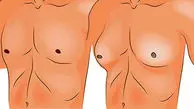 ژنیکوماستی چیست؟ / جدول مواد غذایی مفید و مضر برای ژنیکوماستی