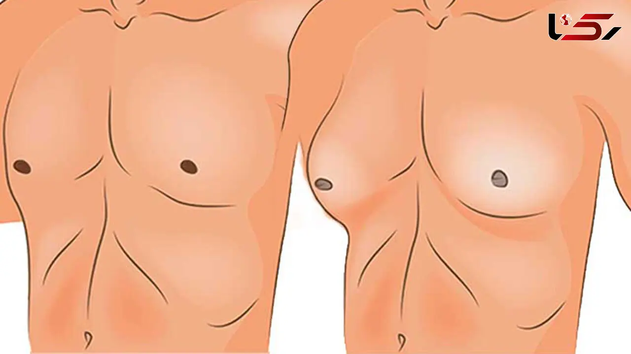 ژنیکوماستی چیست؟ / جدول مواد غذایی مفید و مضر برای ژنیکوماستی