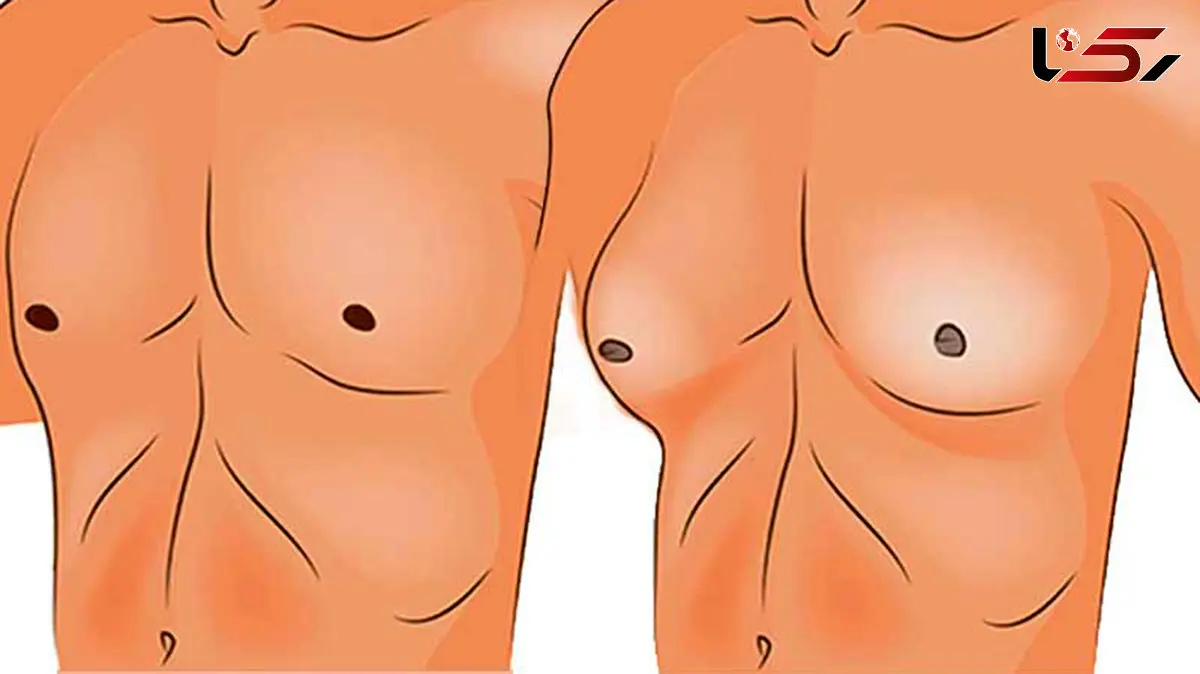 ژنیکوماستی چیست؟ / جدول مواد غذایی مفید و مضر برای ژنیکوماستی