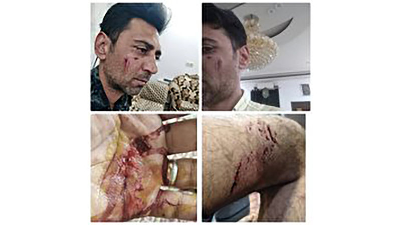  مرگ مغزی پسربچه در حمله سگ ولگرد در شهر زارچ 