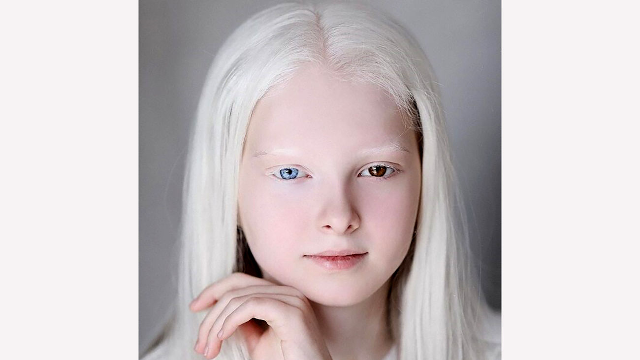 Albino onlyfans