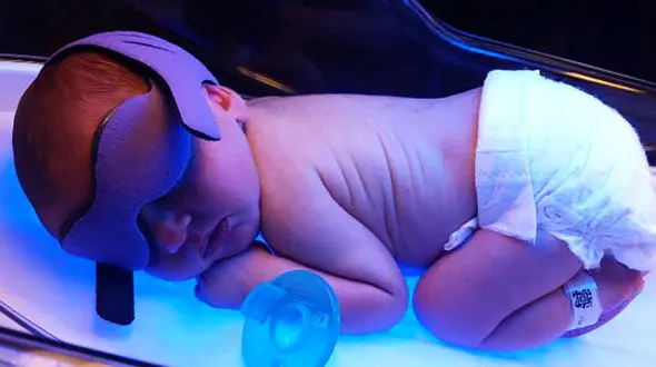 شیوه ای نوین در درمان یرقان نوزادان