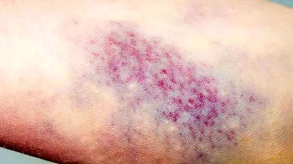 کشف راز زود کبود شدن بدن؛ هر آنچه باید بدانید