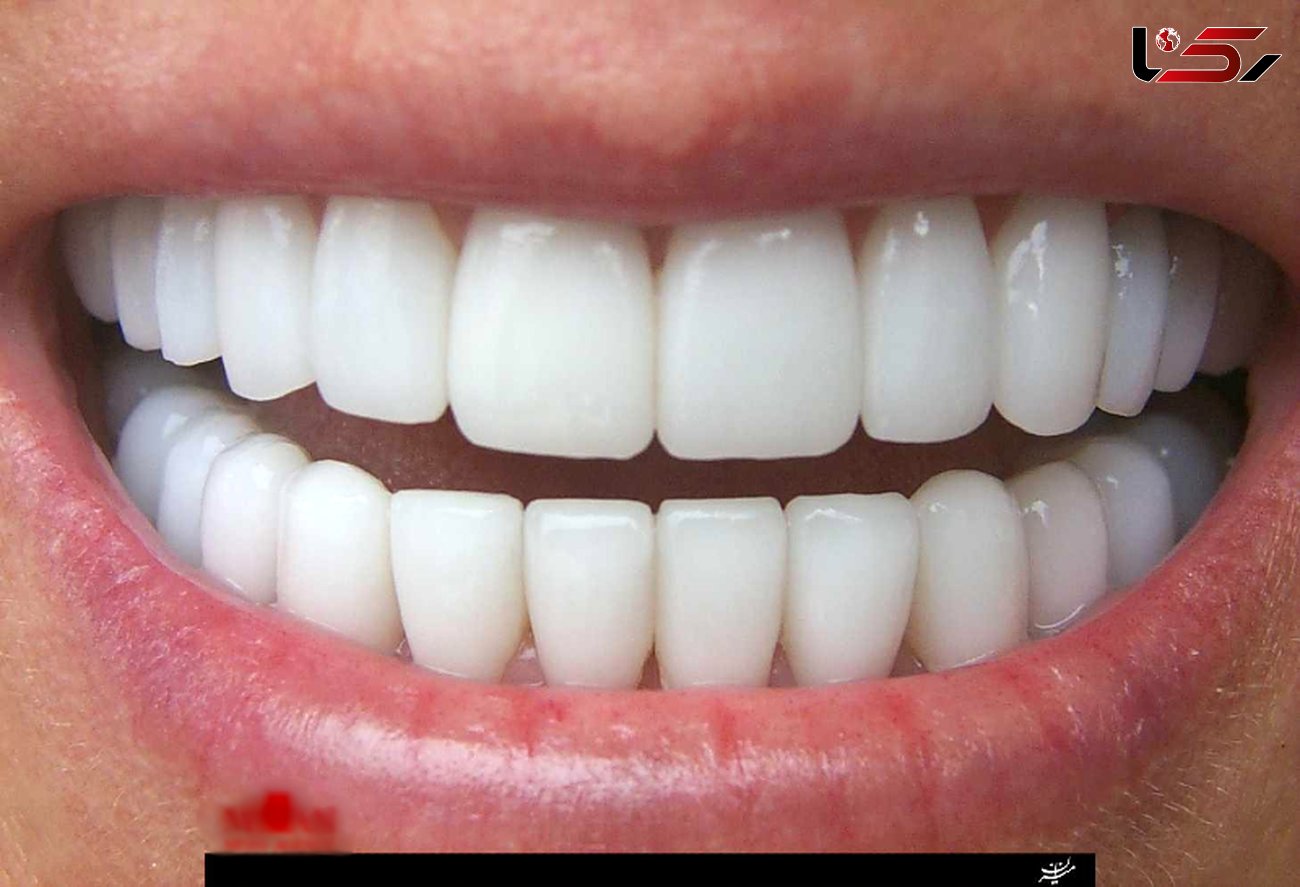 عوارض ناگوار تراشیدن دندان برای زیبایی