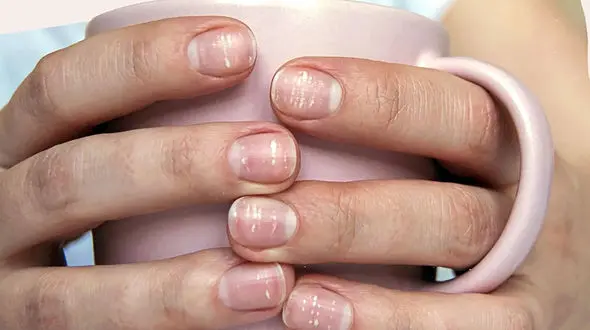 نقاط سفید روی ناخن نشانه کم خونی است؟