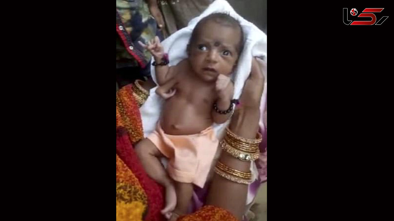 تولد نوزاد دختر با سه دست+عکس