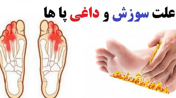 علت سوزش کف پا در شب چیست؟ + جدول جامع 