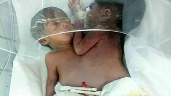 تولد دوقلوهای بهم چسبیده در نیکشهر 