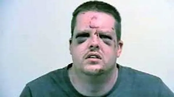 عکس باورنکردنی از صورت کتک خورده مرد قوی هیکل از زن ریز نقش