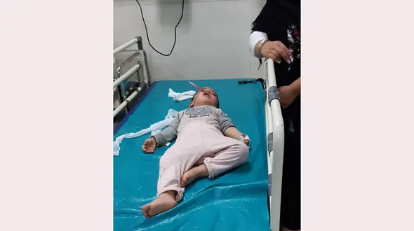فرو رفتن قیچی خیاطی در صورت دختر بچه ۲.۵ ساله در آبیک + عکس تلخ