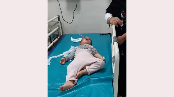 فرو رفتن قیچی خیاطی در صورت دختر بچه ۲.۵ ساله در آبیک + عکس تلخ