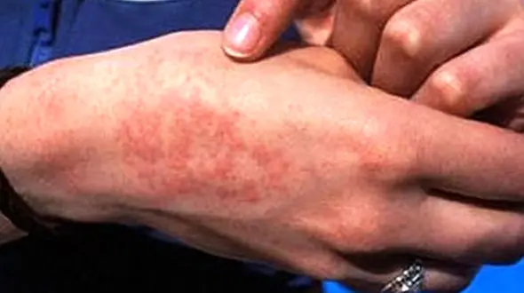 بیماری هزار چهره تب مالت در فصل بهار شایع‌تر است / استان اردبیل رتبه چهارم کشوری از نظر ابتلا به تب مالت 