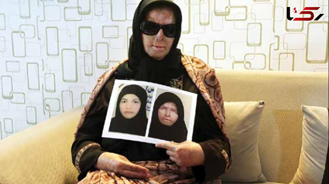 عکس قبل و بعد از اسیدپاشی به چهره زنی در بم + جزییات تکاندهنده