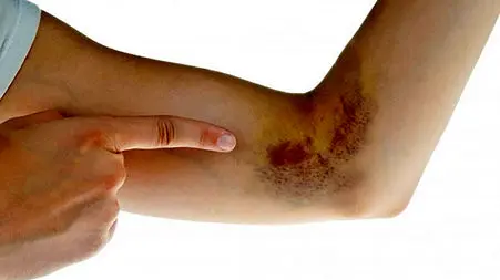 platelets چیست؟