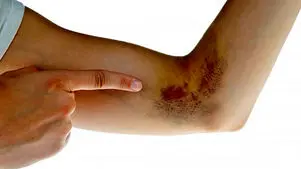 platelets چیست؟