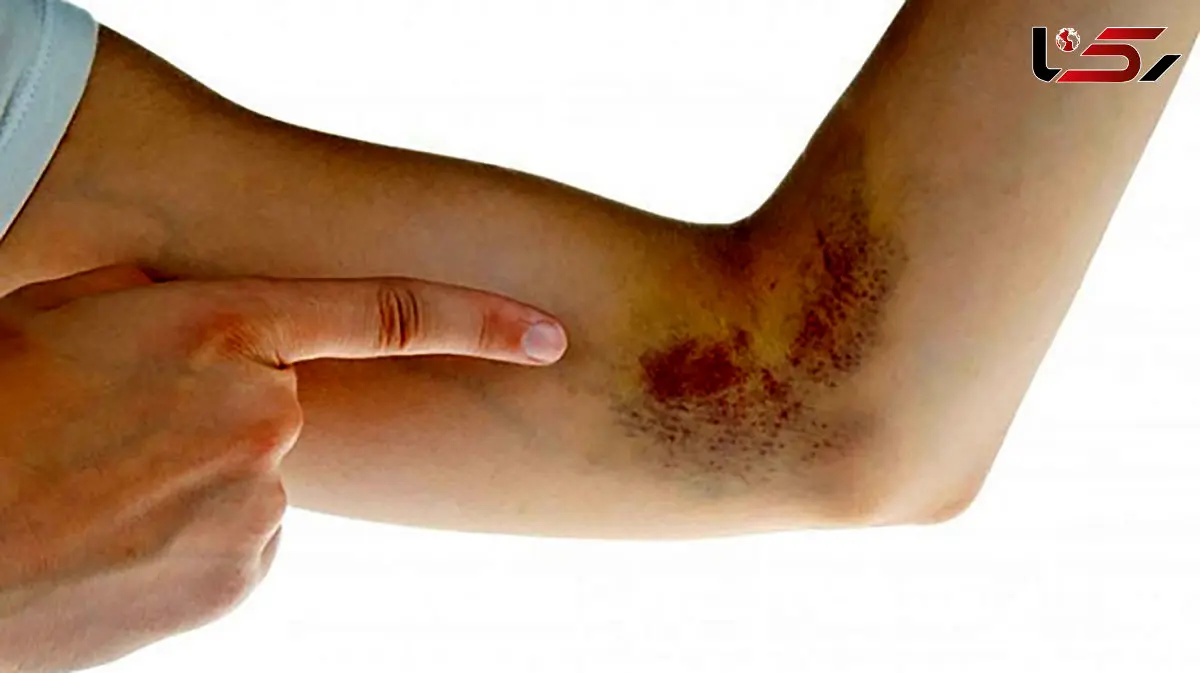 platelets چیست؟