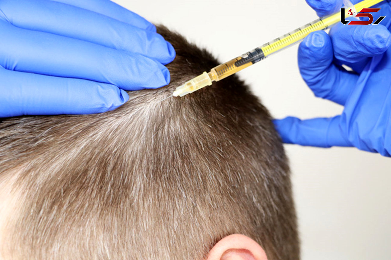نحوه تزریق مزوتراپی مو چگونه است؟