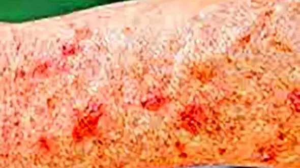 نکات کلیدی برای پیشگیری از سرطان پوست
