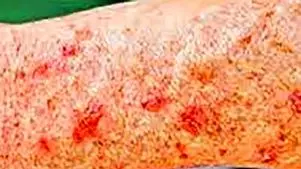 نکات کلیدی برای پیشگیری از سرطان پوست